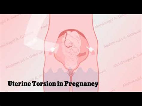 uterine torsion  pregnancy dr abdelmagid gaboura youtube