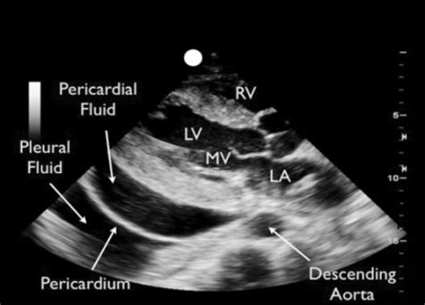 Differentiation Of A Pericardial Effusion From A Pleura Open I