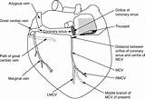 Cardiac Vein Bmj Middle sketch template