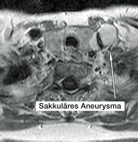 abbildungen und graphiken aneurysma der vena jugularis interna als