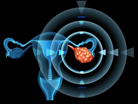ovarian cancer clot risk high in all phases of treatment clearity