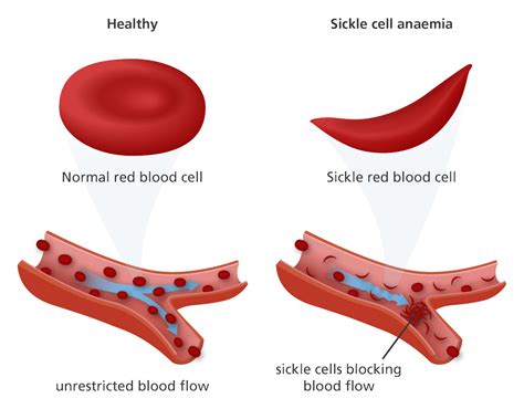 sickle cell disorder sickle cell foundation nigeria