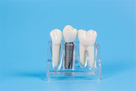 tooth  prepared    dental crown restoration  dental