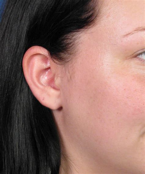 stretched earlobe repair surgery following gauge earring