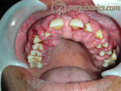 gingival enlargement periobasicscom clinical periodontology