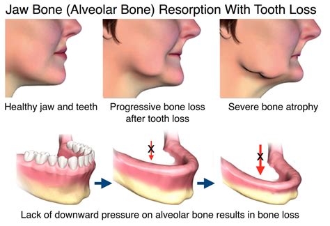 jaw bone health  ventura ca oral health jaw bone disease