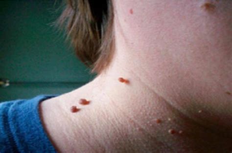 dermatologists remove skin lumps eadvviennaorg