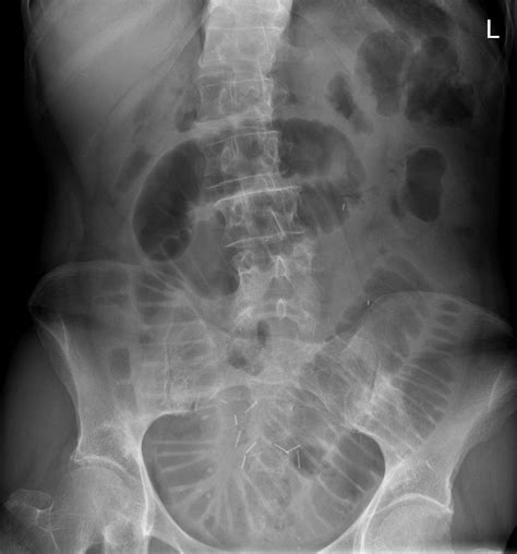 small bowel obstruction adhesions radiology  st vincents