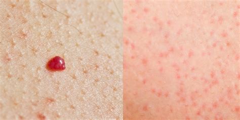 small tiny pinpoint red dots  skin kizacenters