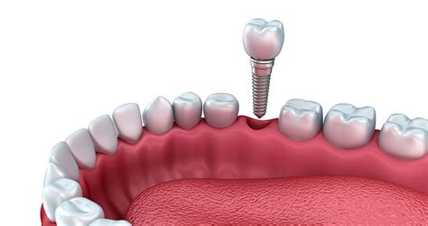 quanto custa implante dentário de um dente consulta ideal