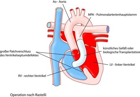 Transposition Der Großen Gefäße Ukm Klinik Für Herz Und Thoraxchirurgie