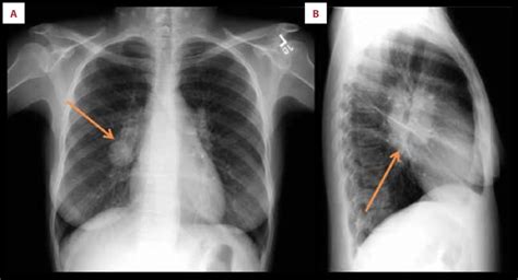 Chest X Ray At Presentation A Frontal View Right Hilar Arrow
