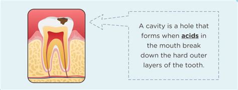 cavity canyon crest dental