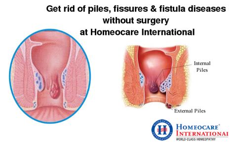 get rid of piles fissures and fistula diseases without