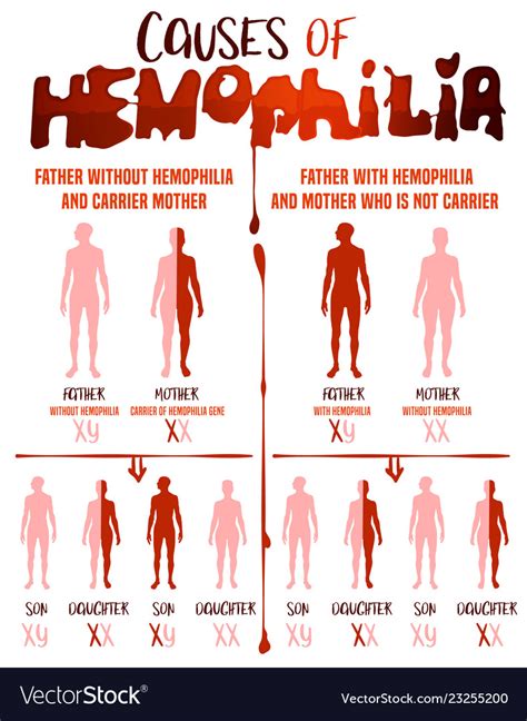 hemophilia causes poster royalty free vector image