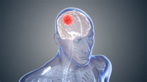 glioblastoma  cancer  brain scientific animations