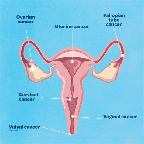 what is gynaecological cancer and what are the symptoms queensland