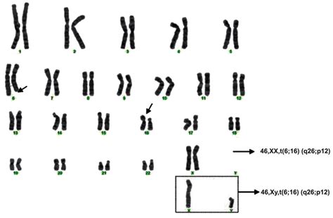 Karyotyping Of A Couple With Balanced Translocation Between Chromosomes