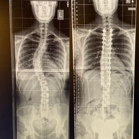 degrees  degrees rscoliosis