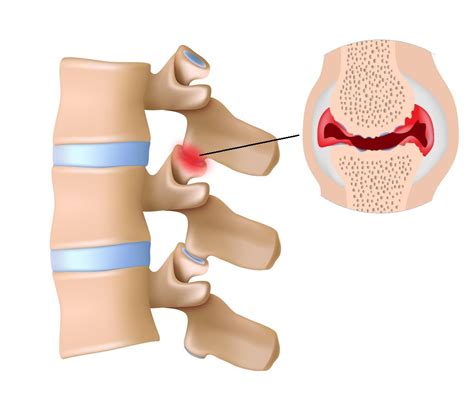 facet joint injuries  family physio