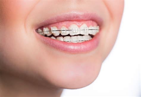 braces shrewsbury nj teeth braces metal braces