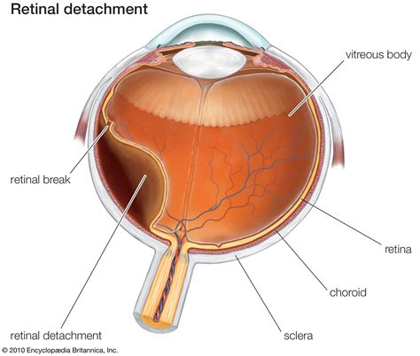 detached retina  symptoms treatment britannica