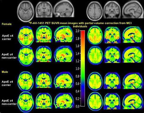 alzheimer s disease sex affects tau accumulation in the brain