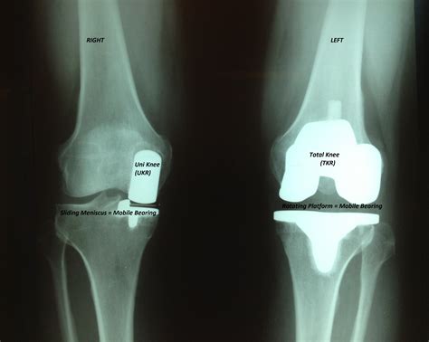 advances  knee replacement scottsdale joint center