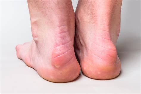 Haglund’s Deformity Causes And Treatment My Footdr