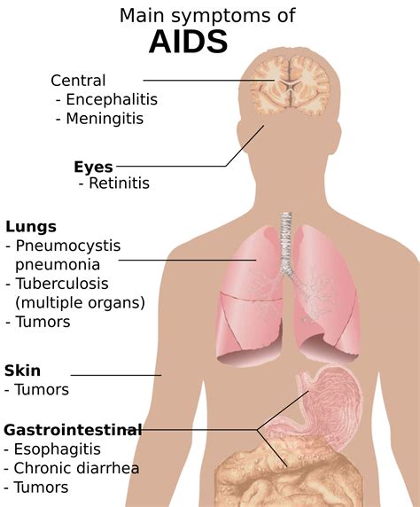 Hiv Symptoms Of All Stages In Women Hiv Aids And Gay