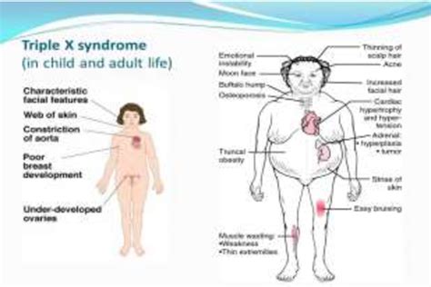 [pdf] Triple X Syndrome A Rare Case Entity With Premature Ovarian