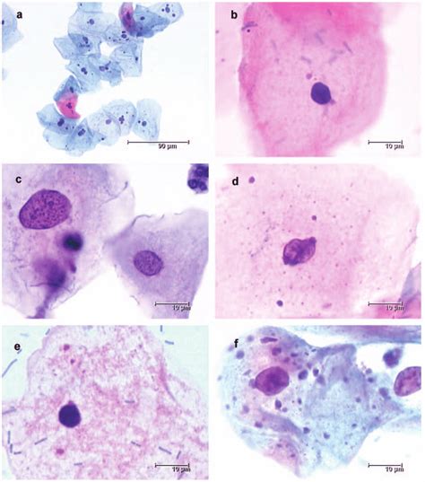A Overview Of A Pap Smear With Minimal Cytological Abnormalities And