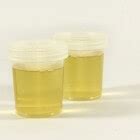 witte stukjes  urine wit uitziende vlokjes  plas mens en gezondheid aandoeningen