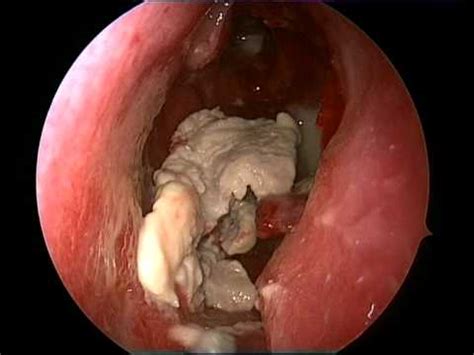 Root canal and sinus polyps