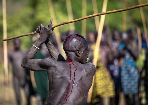 Suri Tribe Warrior Bleeding During A Donga Stick Fighting