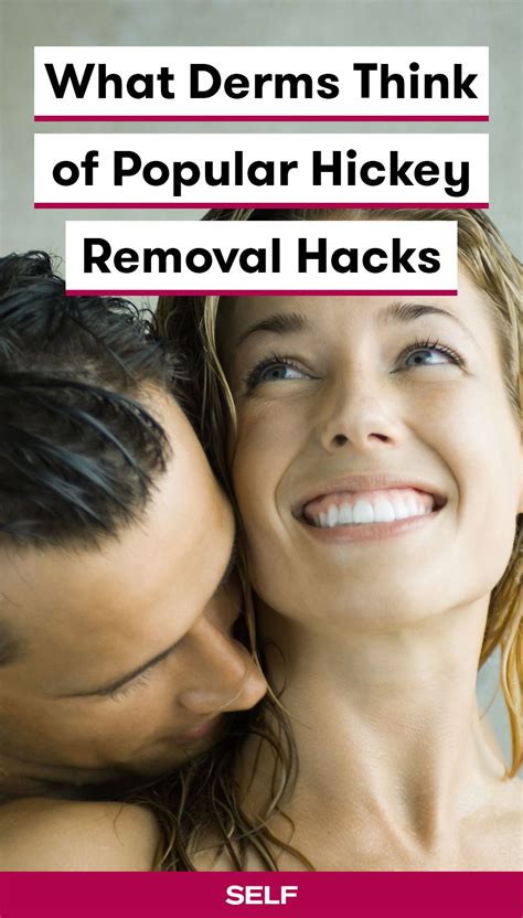 9 of the most popular hickey removal hacks—and what dermatologists actually think of them in