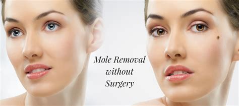 mole removal without surgery what you need to know and how