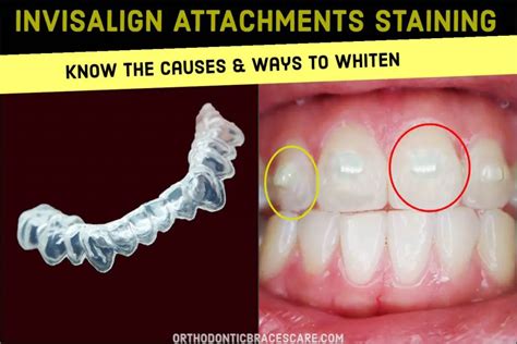 invisalign attachments staining   whiten  clean orthodontic braces care