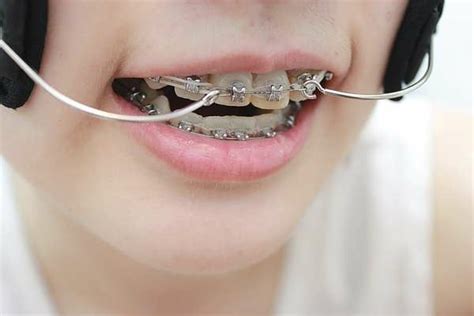 pin by shrood burgos on braces braces girls orthodontics braces
