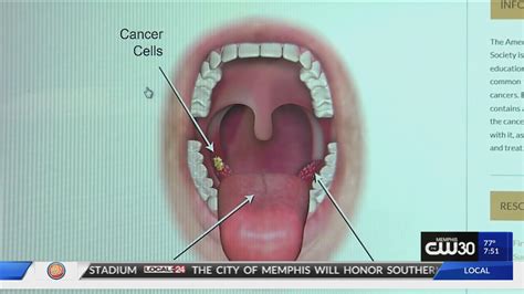 local health alert hpv  related  throat cancer doctors urge