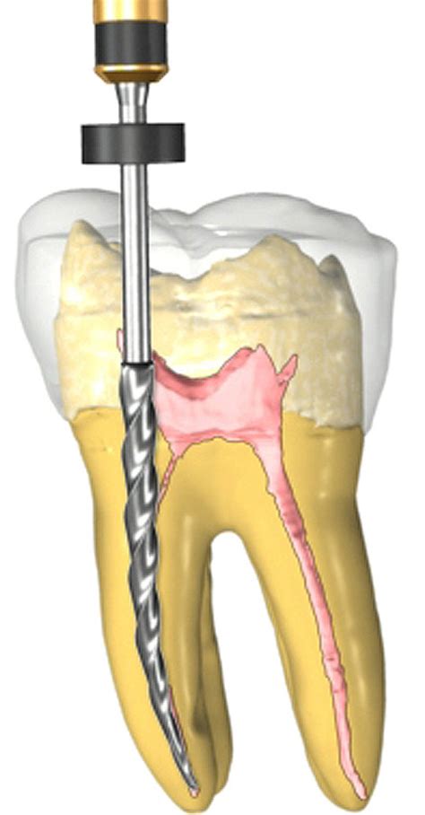 purpose   root canal treatment intelligent dental