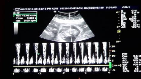 baby  week ultrasound heartbeat youtube