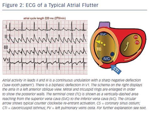 Figure 2 Ecg Of A Typical Atrial Flutter Radcliffe Cardiology