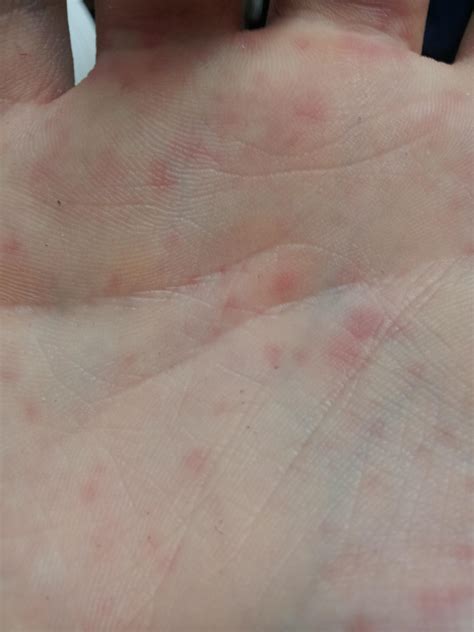 hey   discovered  lot  red spots   hands wrist