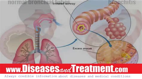 bronchitis causes symptoms diagnosis treatment complications