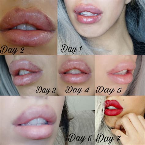 lip filler side effects sy clinic lip fillers lip fillers juvederm