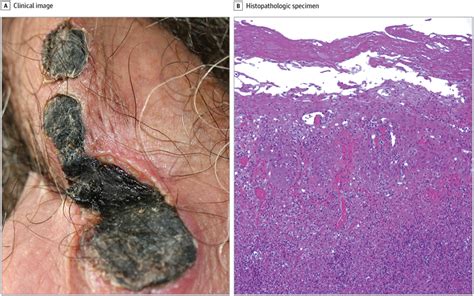 Scrotal Ulceration And Pyrexia Dermatology Jama