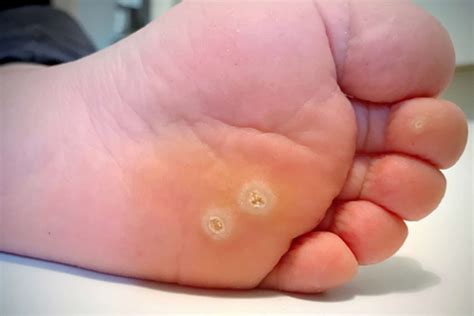 plantar warts foot specialist toronto feet first clinic