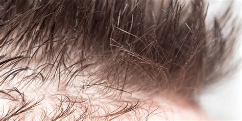 La ricrescita dei capelli la crescita capillare alla pallaoro medical laser è garantita da un documento prodotto immediatamente dopo l’intervento che riporta la quantità di u.f. Trapianto di capelli donna Milano | Dott. Massimo Maspero
