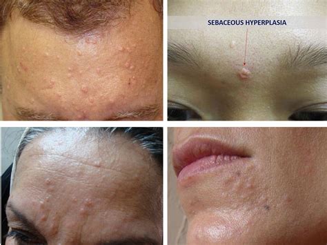 don t panic it s only sebaceous hyperplasia no body problems in